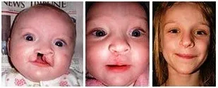 The girl 1 month after surgery and the same girl at 8 yrs of age