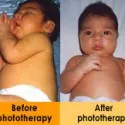 Jaundice in Child