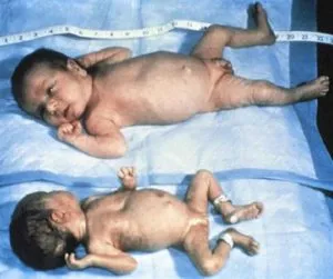 Pre Mature Baby